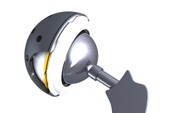 Hip Replacement 4