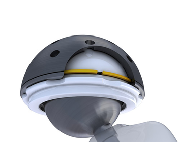 Hip Replacement 1