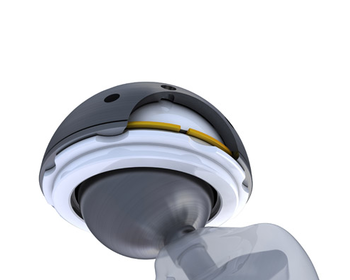 Hip Replacement 3